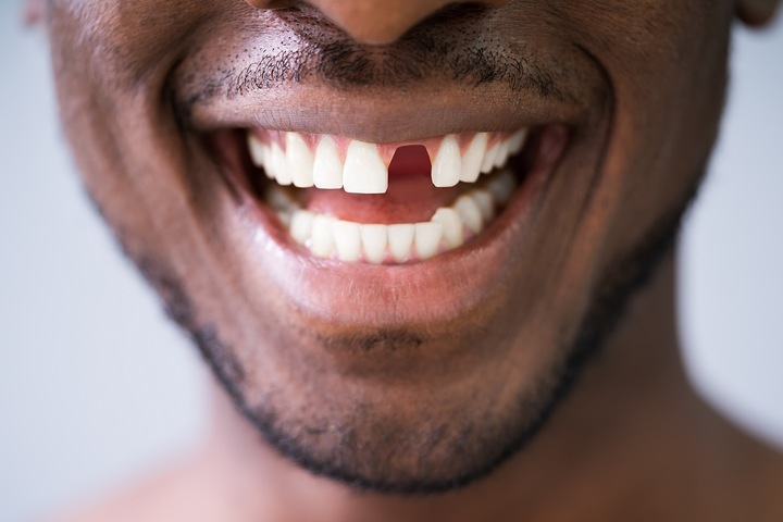 5 Permanent Tooth Replacement Options After Extraction